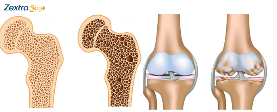 How to prevent osteoporosis vs osteoarthritis